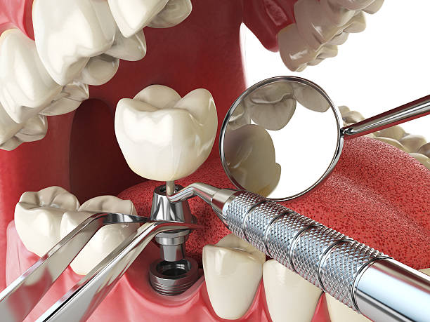 Best Broken Tooth Emergency  in Four Square Mile, CO